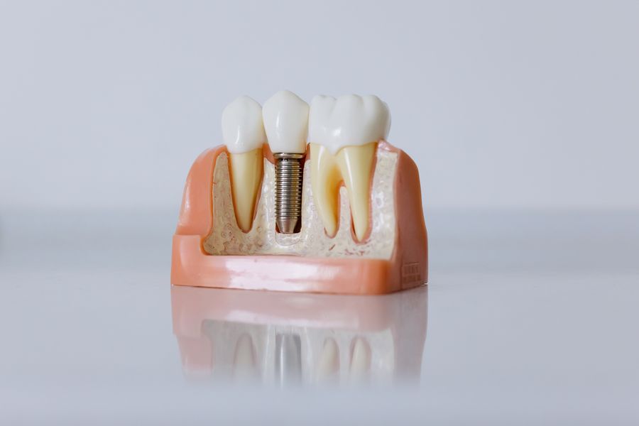 Implantes